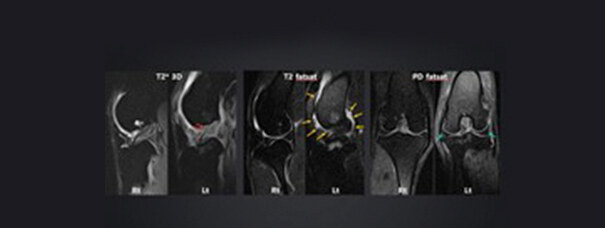 MRI of the stifle showing the cruciate ligament and meniscus