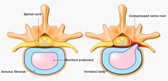 Signs of disc herniation: a normal disc and a herniated disc compressing the nerve root